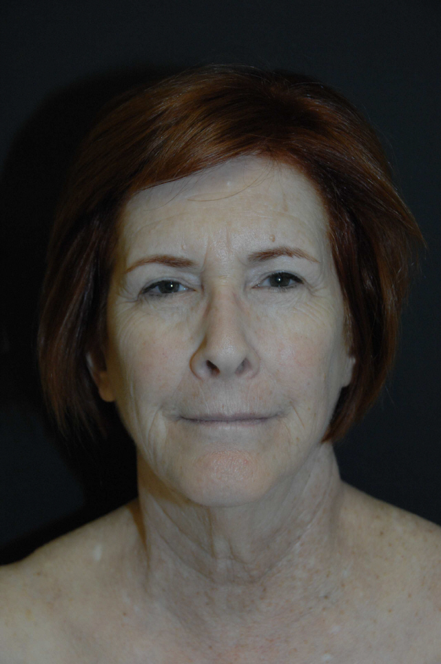 Facelift before and after - before
