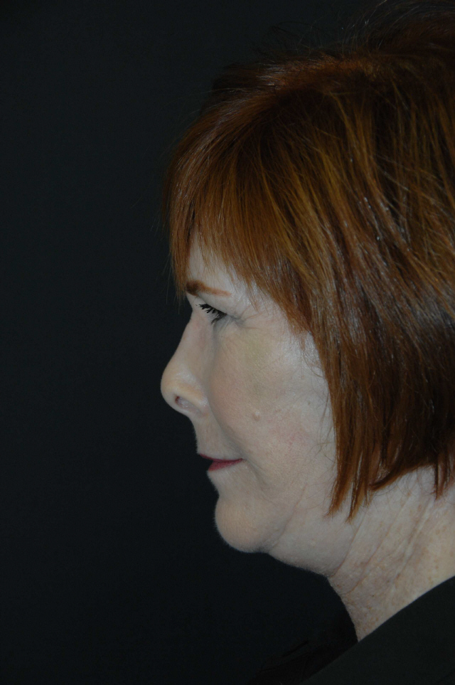 Facelift after — Dr. Lorne Rosenfield