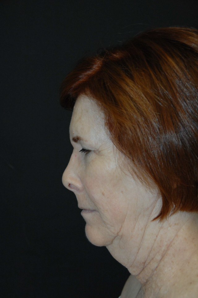 Facelift before — Dr. Lorne Rosenfield