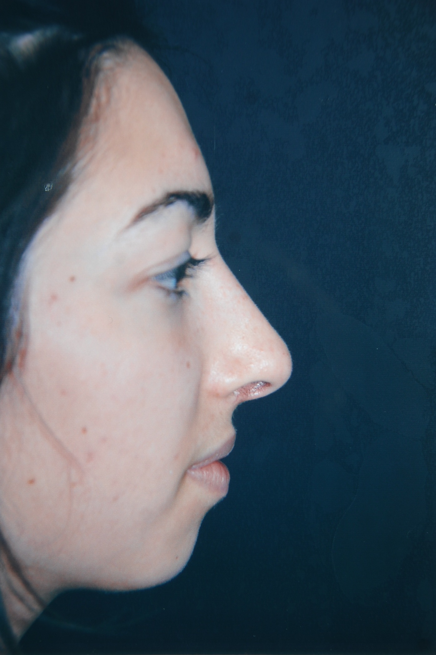 Rhinoplasty after — Dr. Lorne Rosenfield