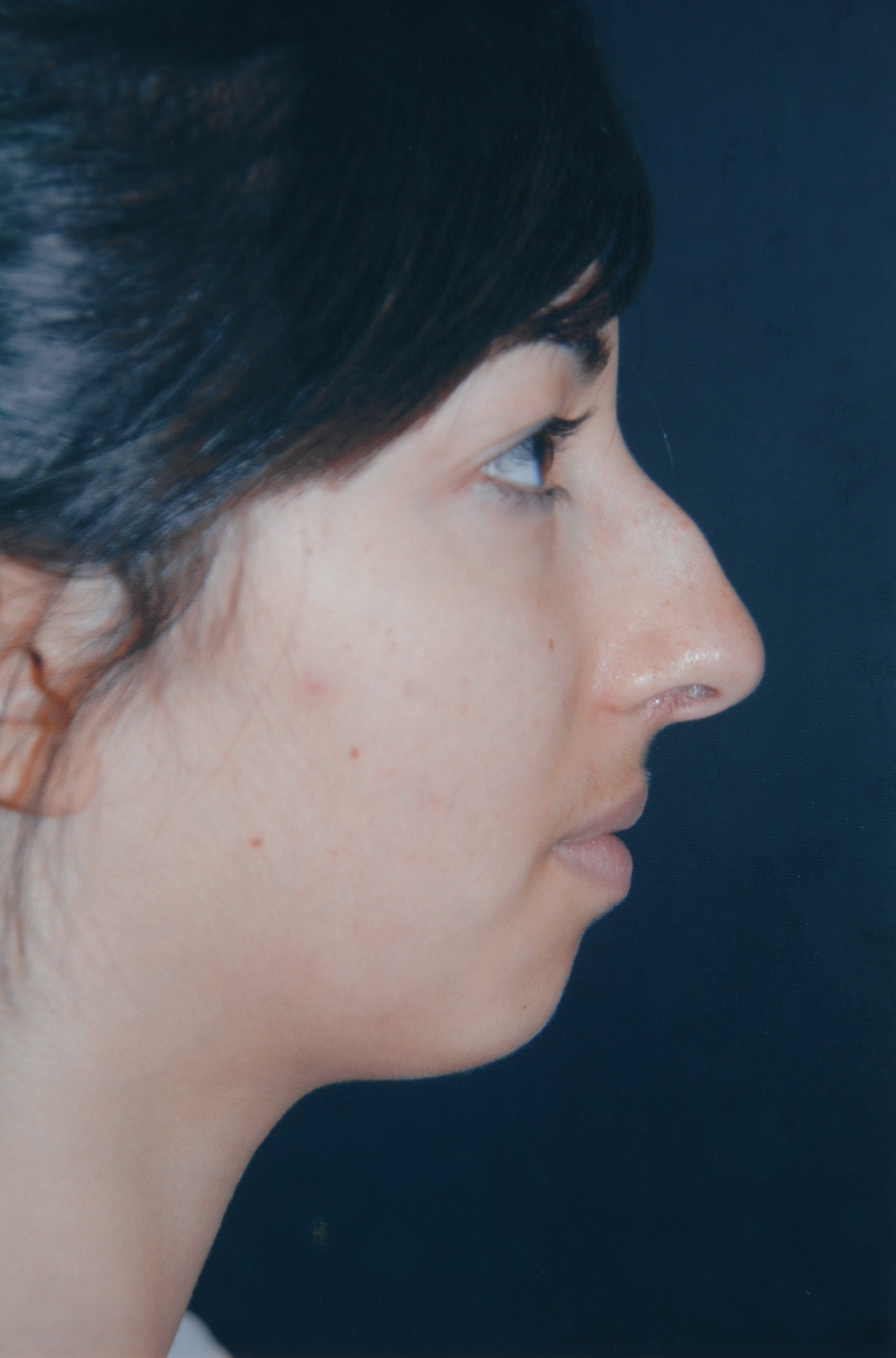 Rhinoplasty before — Dr. Lorne Rosenfield