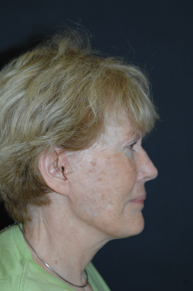 Facelift after — Dr. Lorne Rosenfield