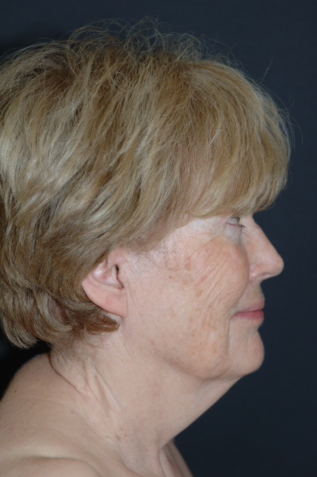 Facelift before — Dr. Lorne Rosenfield