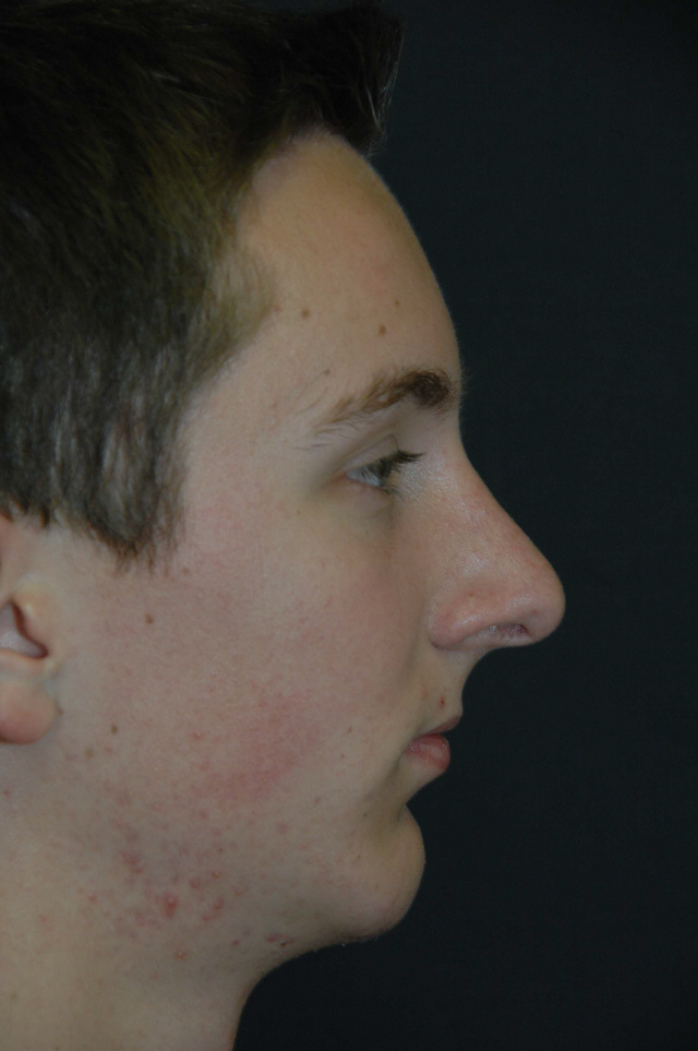 Rhinoplasty before and after - after