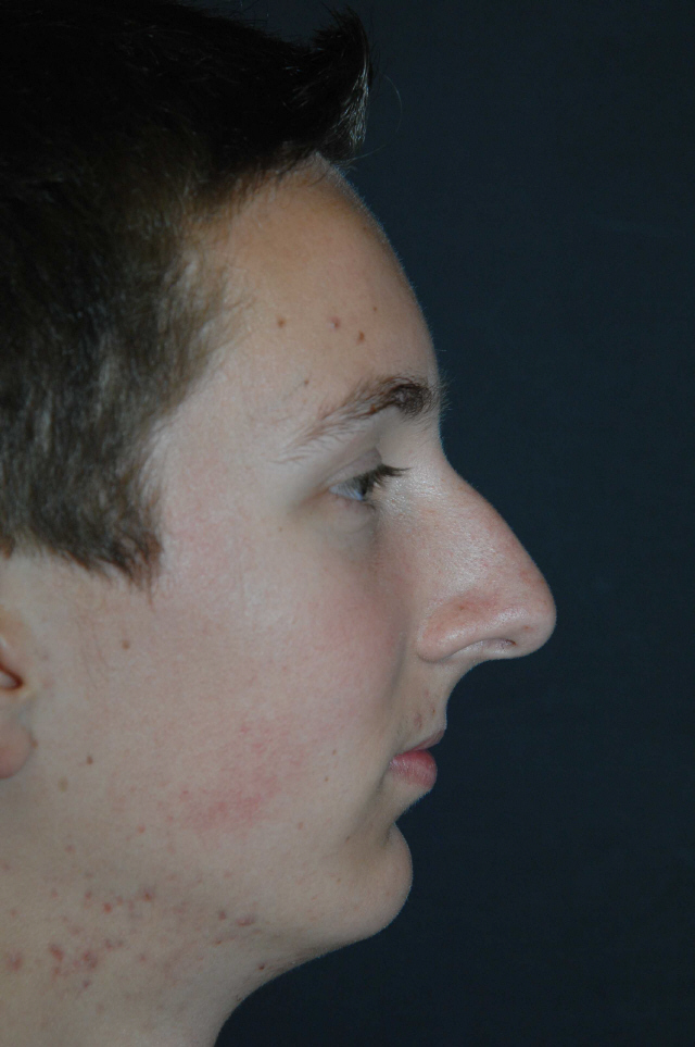 Rhinoplasty before and after - before