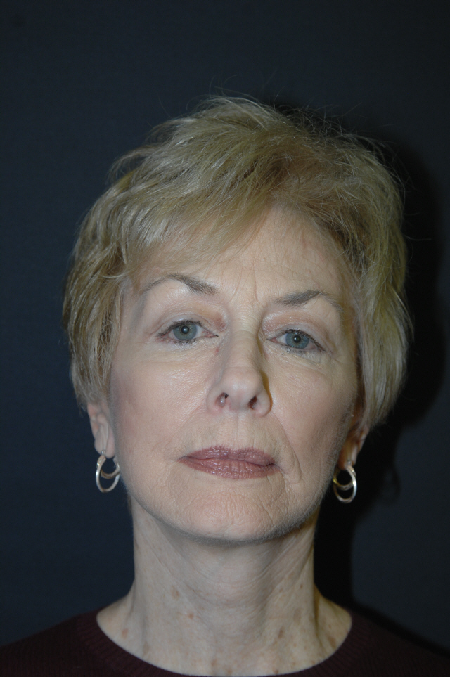 Facelift after — Dr. Lorne Rosenfield