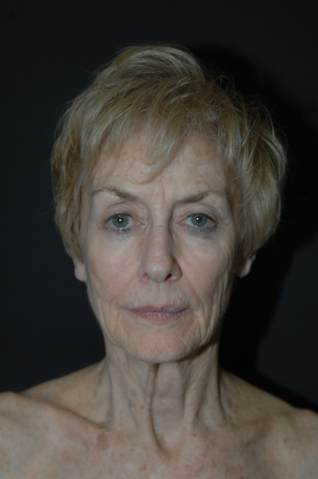 Facelift before — Dr. Lorne Rosenfield