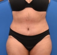 Tummy Tuck before and after - after
