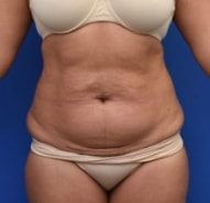 Tummy Tuck before and after - before