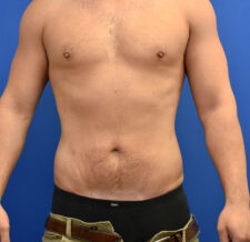 Liposuction before and after - after