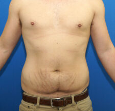 Liposuction before and after - before