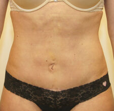 Liposuction before and after - after