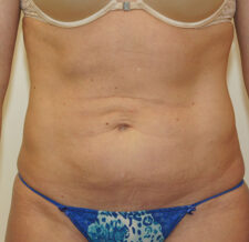 Liposuction before and after - before