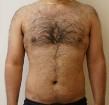 Liposuction before and after - after