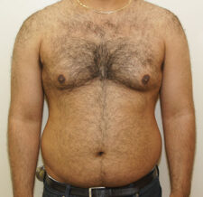 Liposuction before and after - before