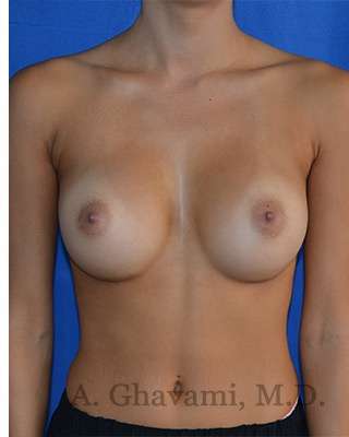 Procedure before and after - after