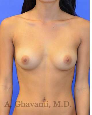 Procedure before and after - before