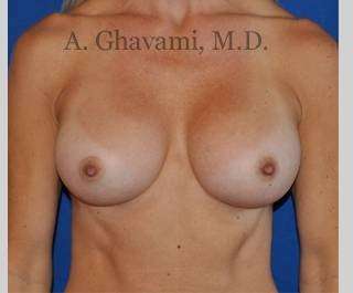 Procedure before and after - after