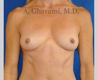 Procedure before and after - before