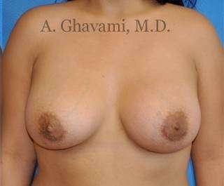 Procedure before and after - after