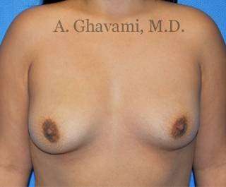 Procedure before and after - before
