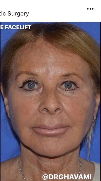 Rhinoplasty before and after - after