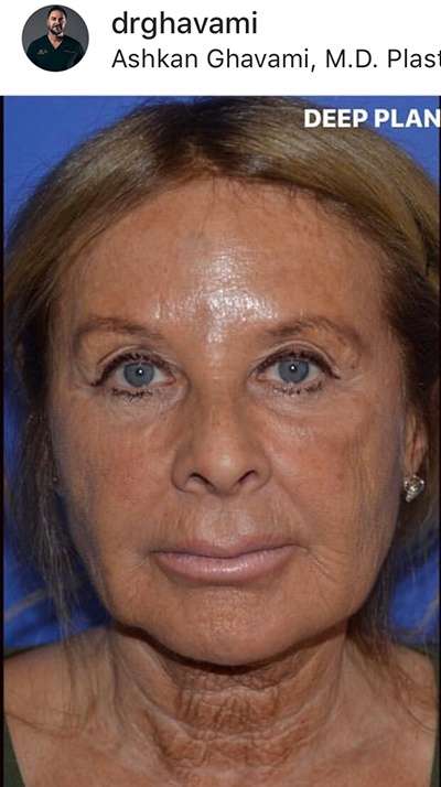 Rhinoplasty before and after - before