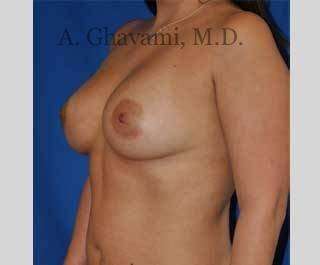 Procedure before and after - after