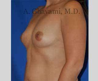 Procedure before and after - before