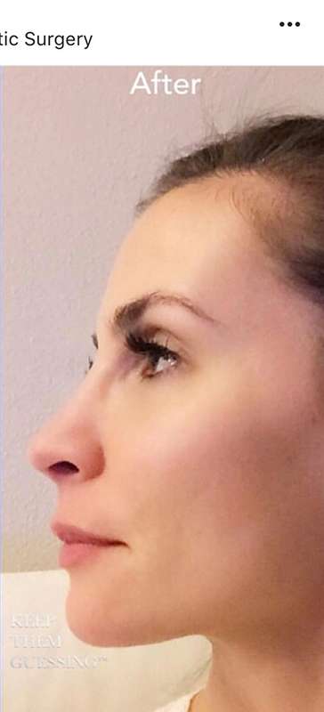 Rhinoplasty before and after - after