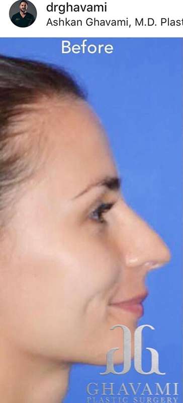 Rhinoplasty before and after - before