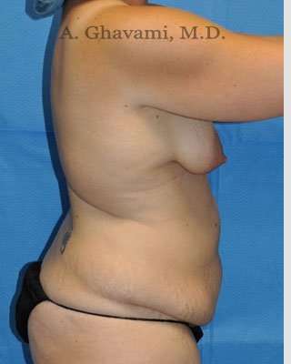Mommy Makeover before and after - before