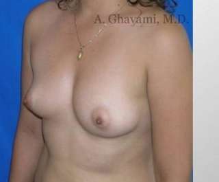 Procedure before and after - before