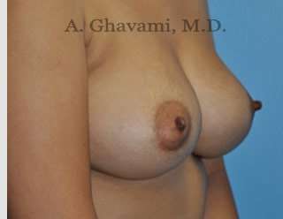Procedure before and after - after