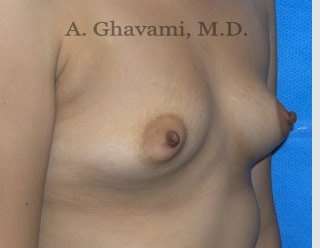 Procedure before and after - before