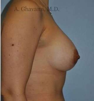 Procedure before and after - after