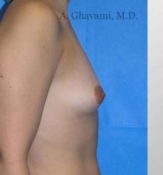 Procedure before and after - before