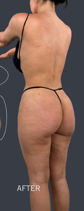 Liposuction before and after - after
