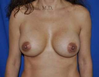 Procedure before and after - after