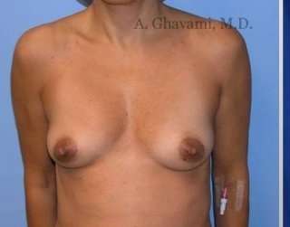Procedure before and after - before
