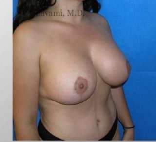 Mommy Makeover before and after - after