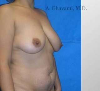Mommy Makeover before and after - before