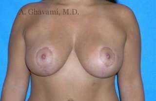 Procedure before and after - after