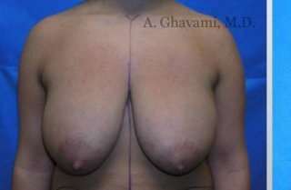Procedure before and after - before
