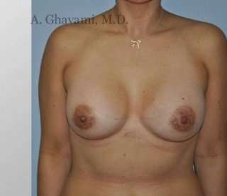 Procedure before and after - after