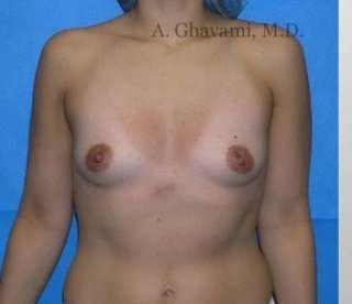 Procedure before and after - before