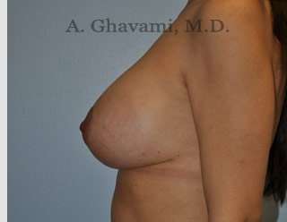 Procedure before and after - after