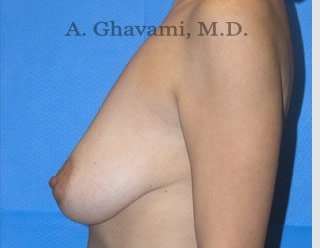Procedure before and after - before