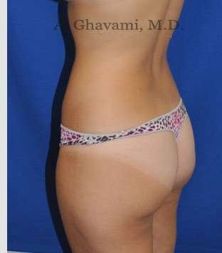 Liposuction before and after - after