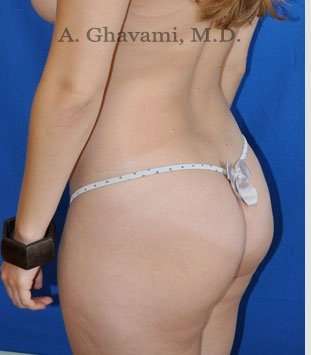 Liposuction before and after - before